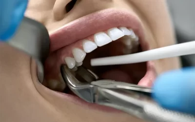 Will an Emergency Dentist Extract a Tooth?