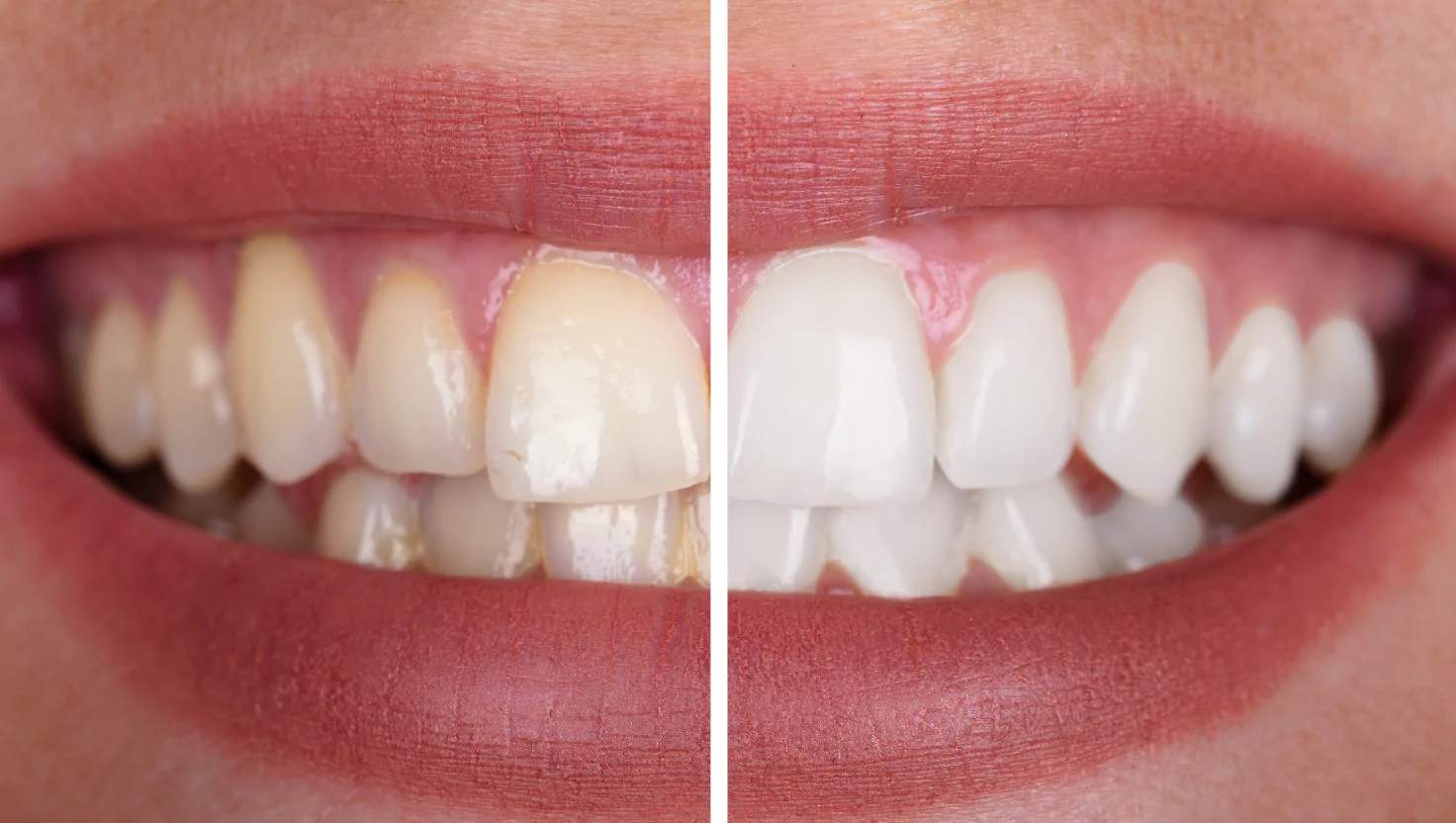 A before-and-after teeth whitening transformation